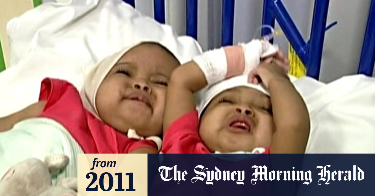 Video Conjoined Twins Separated In Miracle Op